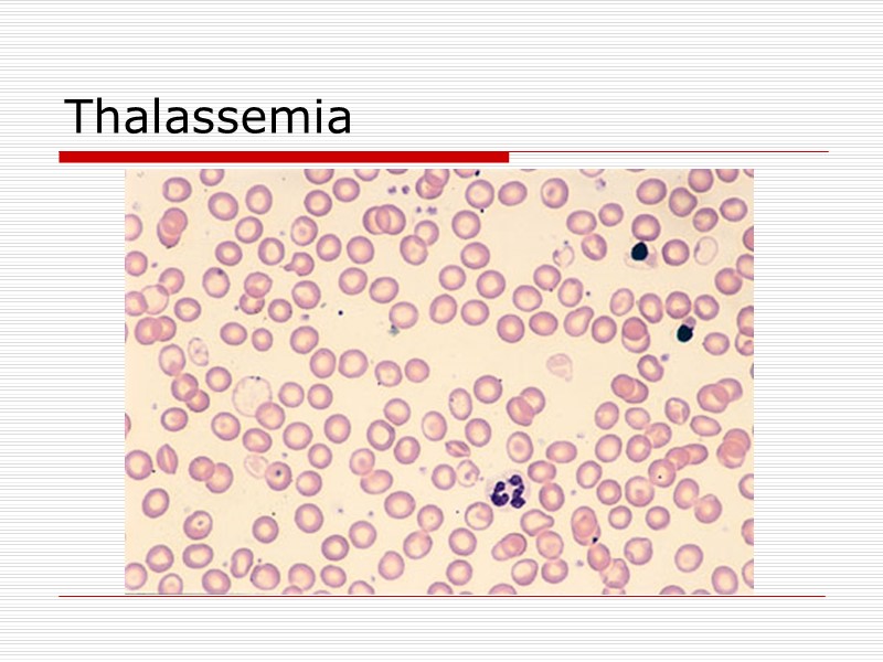 Thalassemia